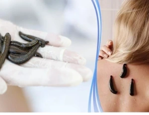 Медицинская пиявка 